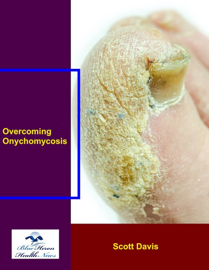 Overcoming Onychomycosis Review 1